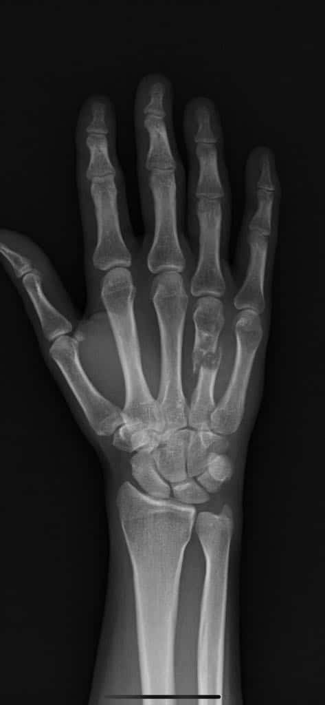X-ray of human hand and wrist bones.